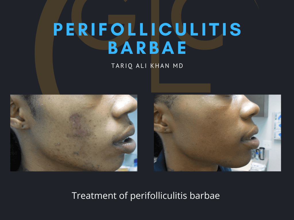 Gentle Care Laser Tustin & Long Beach Before and After picture - perifolliculitis barbae